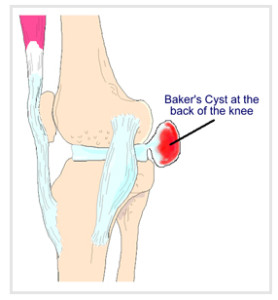 cyst popliteal bakers cyste term osmo