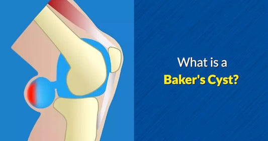 What is a Baker's Cyst by OSMO Patch
