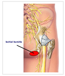 Steroid injection retrocalcaneal bursitis