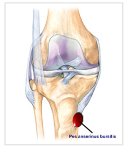 Pes_anserine_bursitis