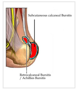 Subcutaneous calcaneal bursitis exercises sale
