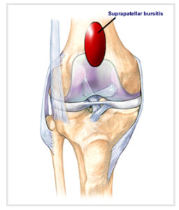 Suprapatellar_bursitis