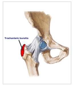 Natural Treatment For Hip Pain Natural Treatment For Hip Pain