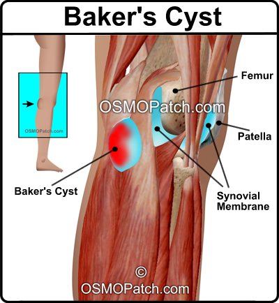 Baker's Cyst