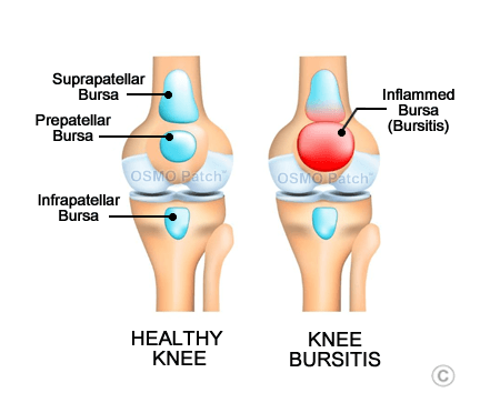 Knee Bursitis - OSMO Patch