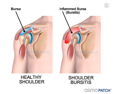 Shoulder Bursitis before & after - OSMO Patch - UK