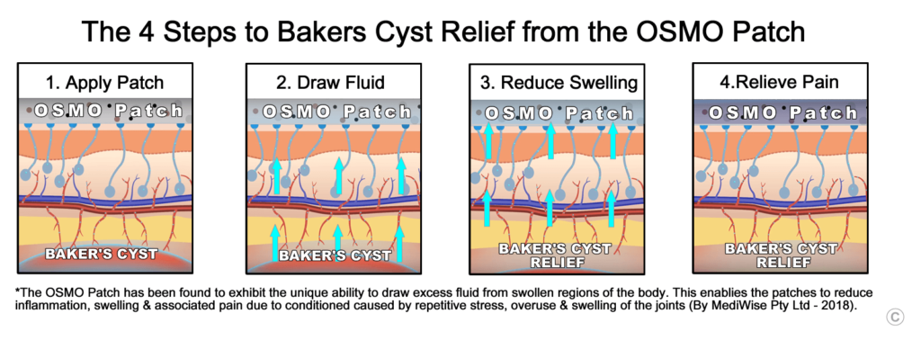 Baker's Cyst Relief - OSMO Patch